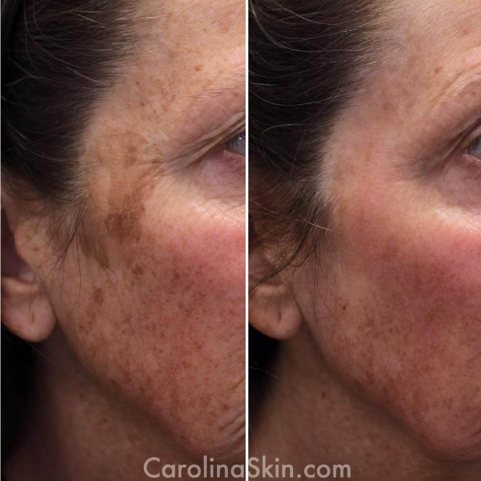 Fraxel DUAL Laser Treatments Charlotte NC DLVSC