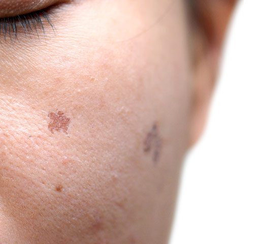 Brown Spots / Freckles - Dermatology, Laser & Vein Specialists of the ...