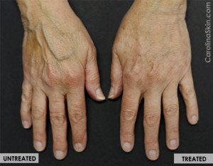 Hand Vein Treatments 