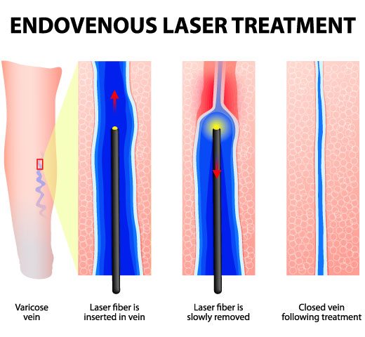 What To Expect After Varicose Vein Treatment