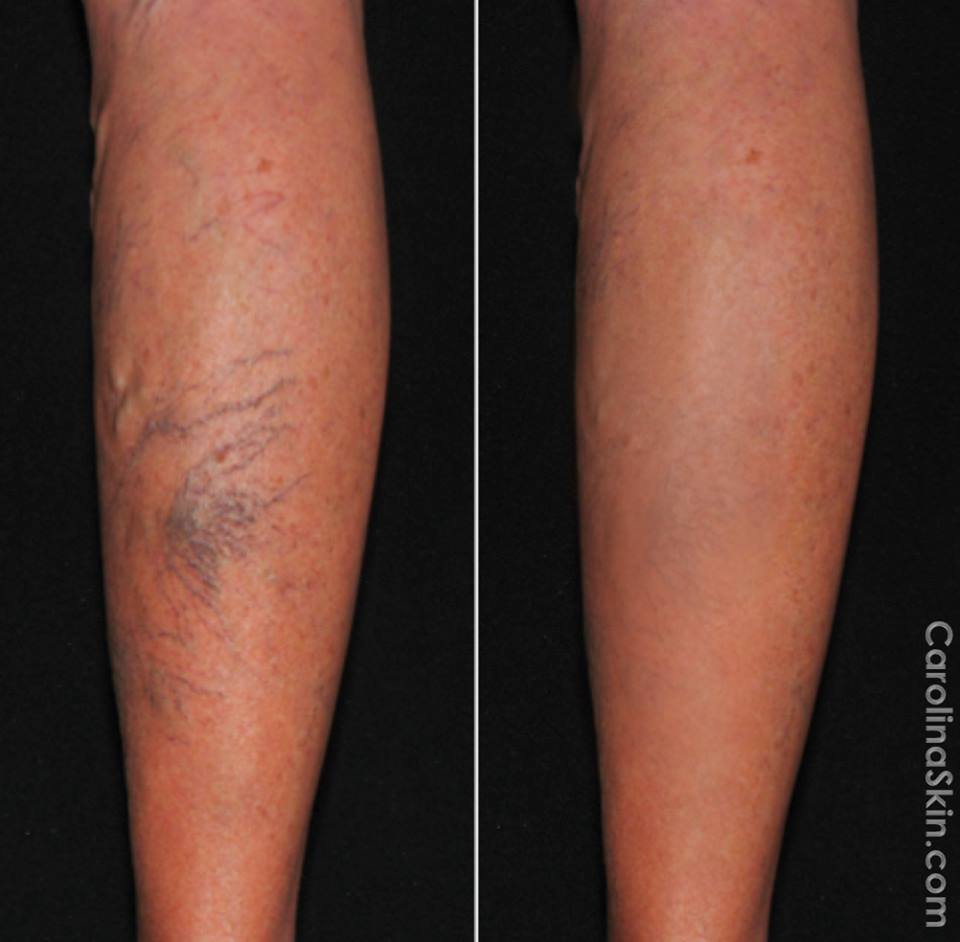 Vein Center New Dermatology Laser And Vein Specialists Of The Carolinas